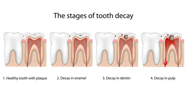 Stages Of Tooth Decay Cosmetic Dentist San Juan Capistrano