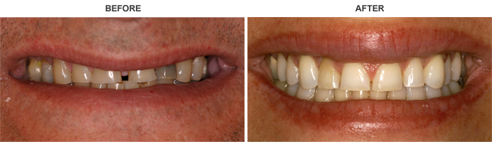 Bruxism Treatment Teeth Grinding Mission Laser Dentistry