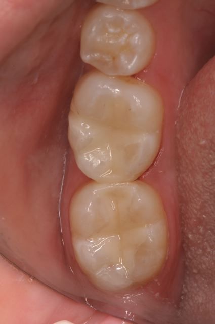 white fillings