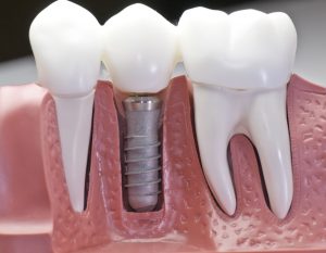 picture of a dental implant with teeth that have been capped and the stainless pin in the gums.