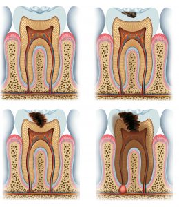 evolution of tooth decay