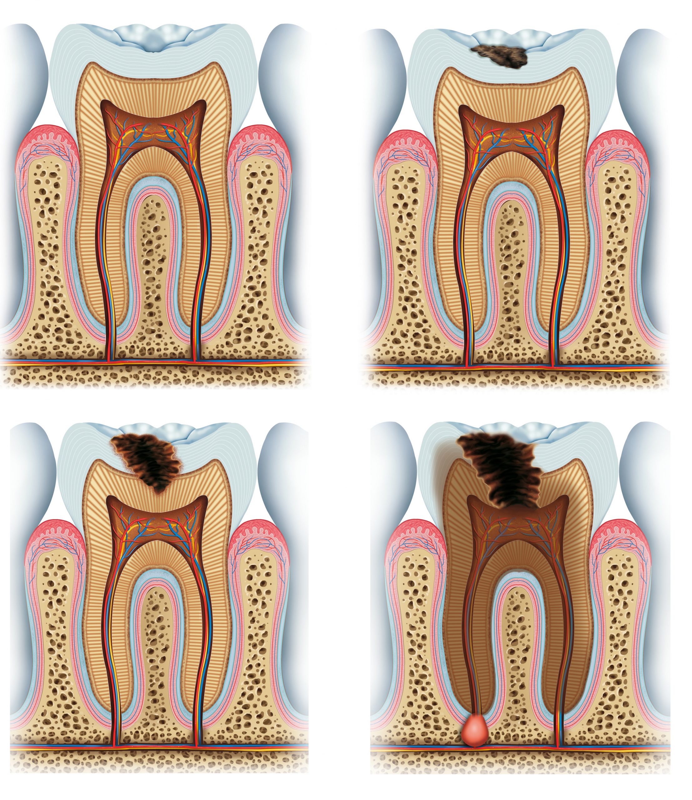 etapas-de-la-caries-estructura-de-la-anatom-a-dental-incluyendo-el