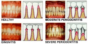 periodontal disease collage