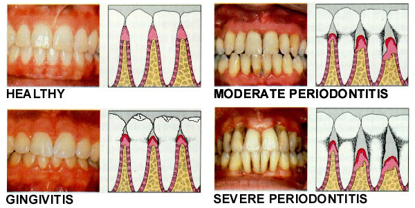 periodontal-disease-collage