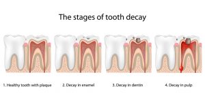 The stages of tooth decay chart